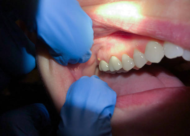 Best Tooth Infection Emergency Dentist  in Dawsonville, GA